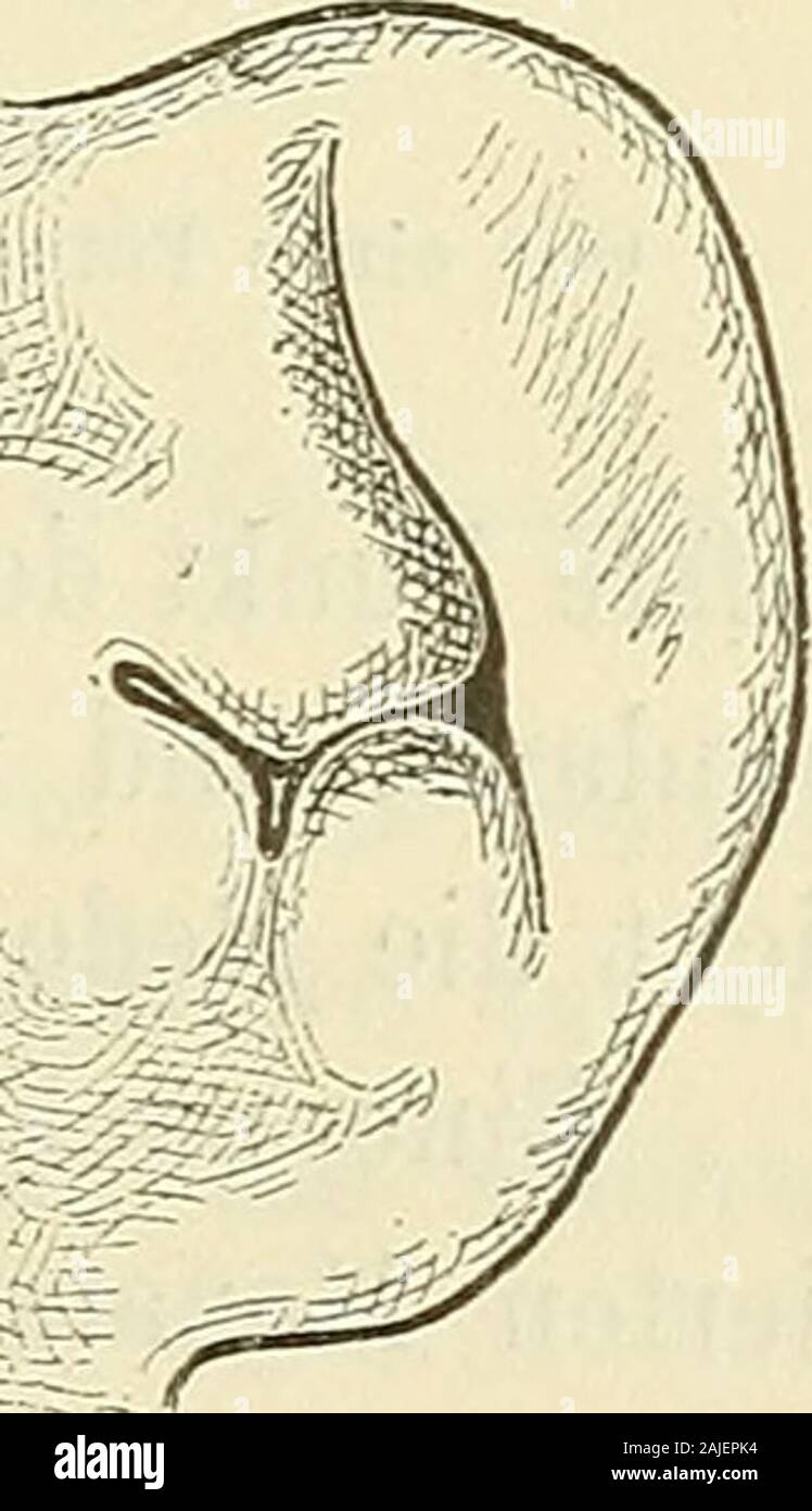 Anatomie menschlicher Embryonen . Anthelix und dieFossa angularis völlig  überdeckt werden. Die-selbe Veränderung tritt auf entsprechenderStufe auch  bei Säugethierohren ein (Schaf,Schwein u. s. w,), und während der Zeit  kommtes bei diesen zur