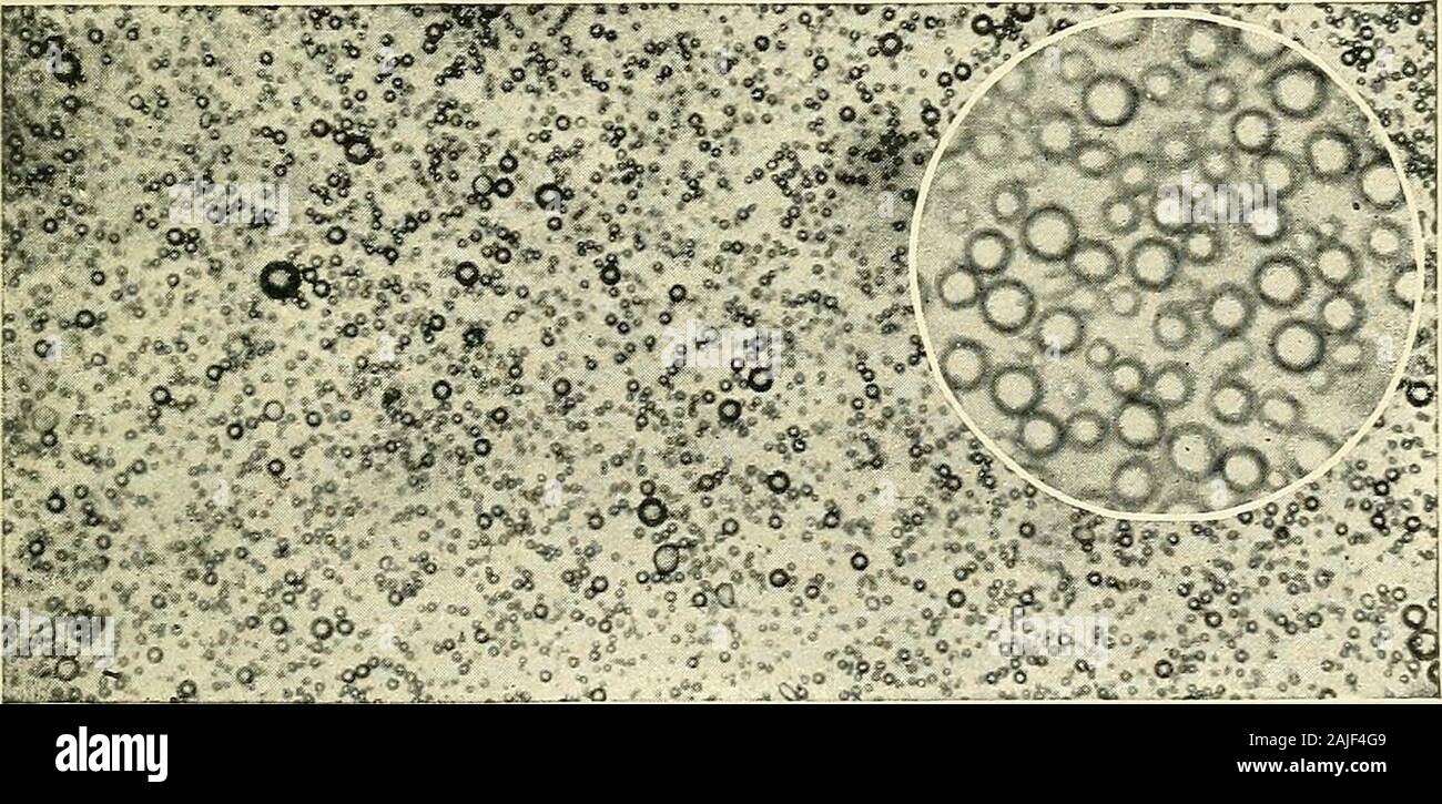 The theory and practice of infant feeding, with notes on development . Fig. 8.—Microscopic Appearance of Normal Milk. (Babcock and Russell.) Fat globules in clusters.. Fig. 9.—Microscopic Appearance of Centrifuged, or Heated Milk. (Babcock and Russell.) Fat globules not in clusters. twenty per cent of fat, is often apparently not thickerthan rich milk. Heating milk also prevents its creamingwell. 43. Centrifugal Cream.—The first centrifugal cream 74 INFANT FEEDING. separators were simple buckets of milk which were whirleduntil the cream rose, when it was skimmed by hand. Latera circular bowl w Stock Photo