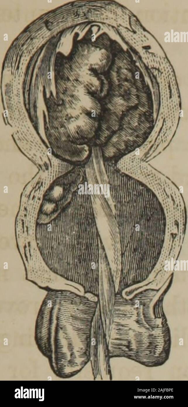 The Principles And Practice Of Obstetrics Ined Should Be Thrown Into The Cavity Of Theuterus Three Or Four Times A Day To Wash Away Thefluids And The Fragments Of The Placenta