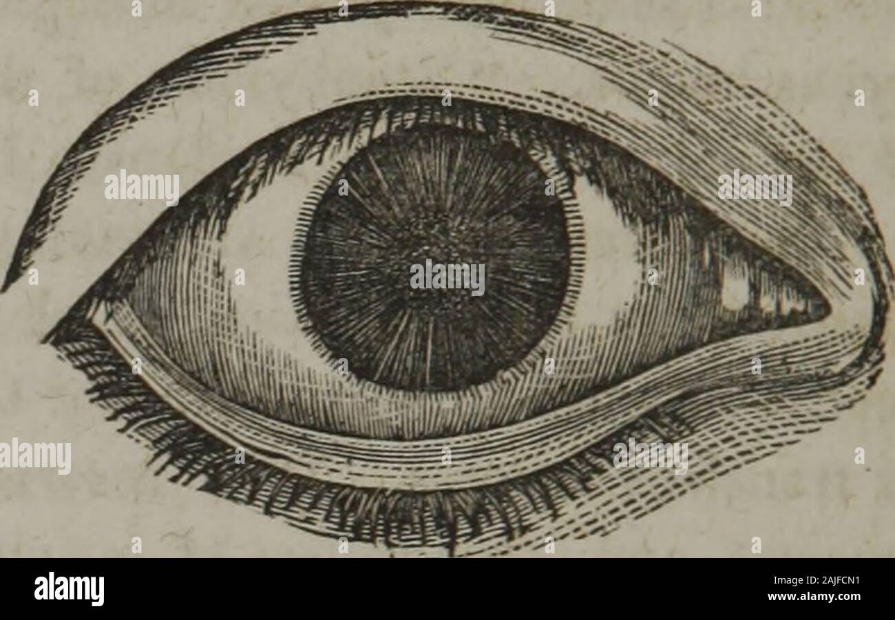 The homeopathic practice of surgery : together with operative surgery . 174 OPERATIONS FOR CATARACT.. In simple capsular cata- Fig. 117. RACT, when the opacity is inthe anterior portion of thecapsule, there is usually apearly white spot in the cen-tre of the pupil, with a dark-ening bluish circle around it.The posterior capsular opac-ity (Fig. 118) is easily distin-guished, being at some distance behind the Iris, and appearingconcave, yellowish and striated. By far the most common ria. Ho. cases are those in which boththe substance of the lens andits covering are involved, pre-senting the ming Stock Photo