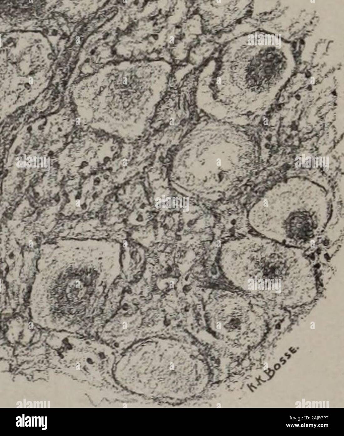 Pediatrics. . entire nucleusappears to have dropped out. The ...
