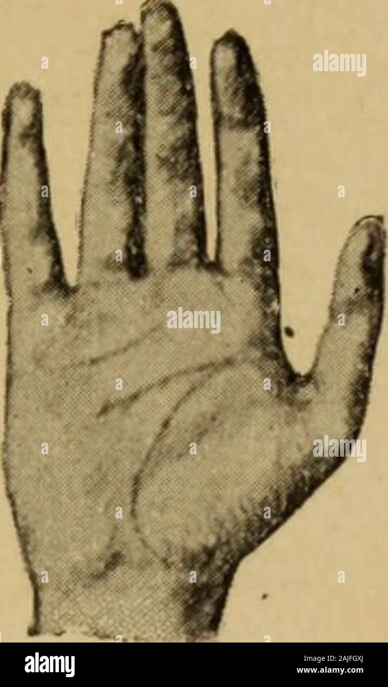 I problemi della degenerazione . Tipo inferiore Solchi palmari.Fig. 18. sovente trasmessa per eredità omosessuale; nellasostanza pigmentaria, i nei (lisci, verrucosi o pe-losi), le leucodermie, diffuse {albinismo) o a chiazze(Tav. IX); nella superficie volare del metacarpo, iltragitto incompleto dei solchi, la riduzione più omen notevole del loro numero, il loro andamentotrasversale non più curvilineo ed obliquo (fig. 16);nelle falangette, la disposizione primigenia, quale siha nelle razze inferiori, delle papille tattili, la loropiù frequente asimmetria nei pollici (DAbundo ), - 362 — la tend Stock Photo