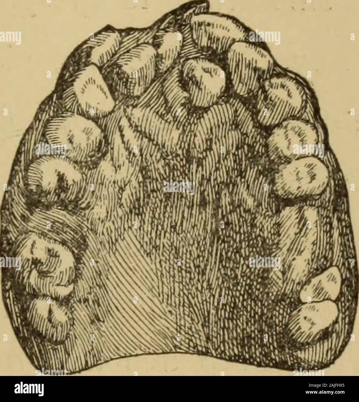 I problemi della degenerazione . FUSIONE DENTARIA — 355 — gior cospicuità degl inferiori rispetto ai supe-riori e in questi degli esterni rispetto ai mediani,T enorme grossezza degli unicuspidi, il loro in-curvamento, la loro sporgenza (tipo belluino), il. Eterotopia dei denti incisivi. (Talbot).Fig. 14. crescere invece che il decrescere dal primo alterzo dei grossi molari (attributo scimiesco ), lacomparsa in quelli del mascellar superiore di unquarto tubercolo (come nei Platerrini ), la vitalitàdel dente della saggezza, che nelle razze incoltesembra mancare men sovente che nelle incivi-lite Stock Photo