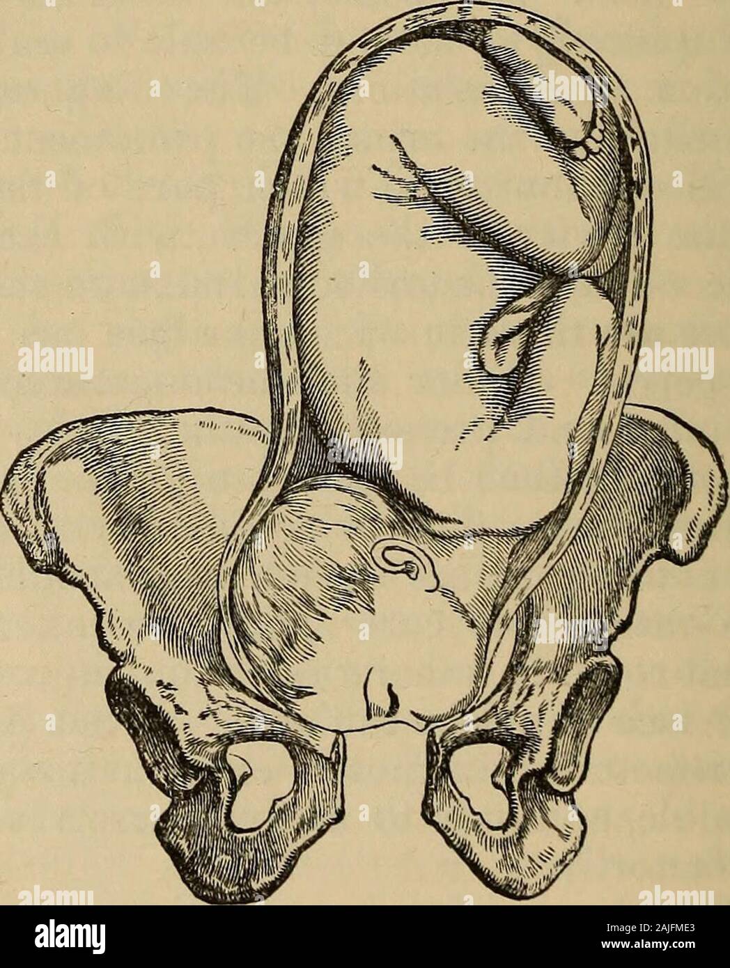 A treatise on the science and practice of midwifery . ipal varieties of ...
