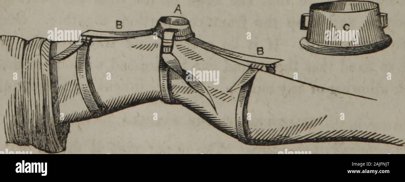 The homeopathic practice of surgery : together with operative surgery . g down the calf ofthe leg. Apply a roller from thetoes to the knee, and affix the splintfirmly to the thigh. The dividedparts may be brought together inthis way: Straps are buckled roundbelow the lower part and above theupper, and drawn together by means of other straps attached tothem, and meeting longitudinally at the sides of the knee. Pullthe circular straps up and down, until the fractured parts cometogether, and then secure them firmly. Unless perfect coaptationbe preserved, the union will be only ligamentous. Longit Stock Photo