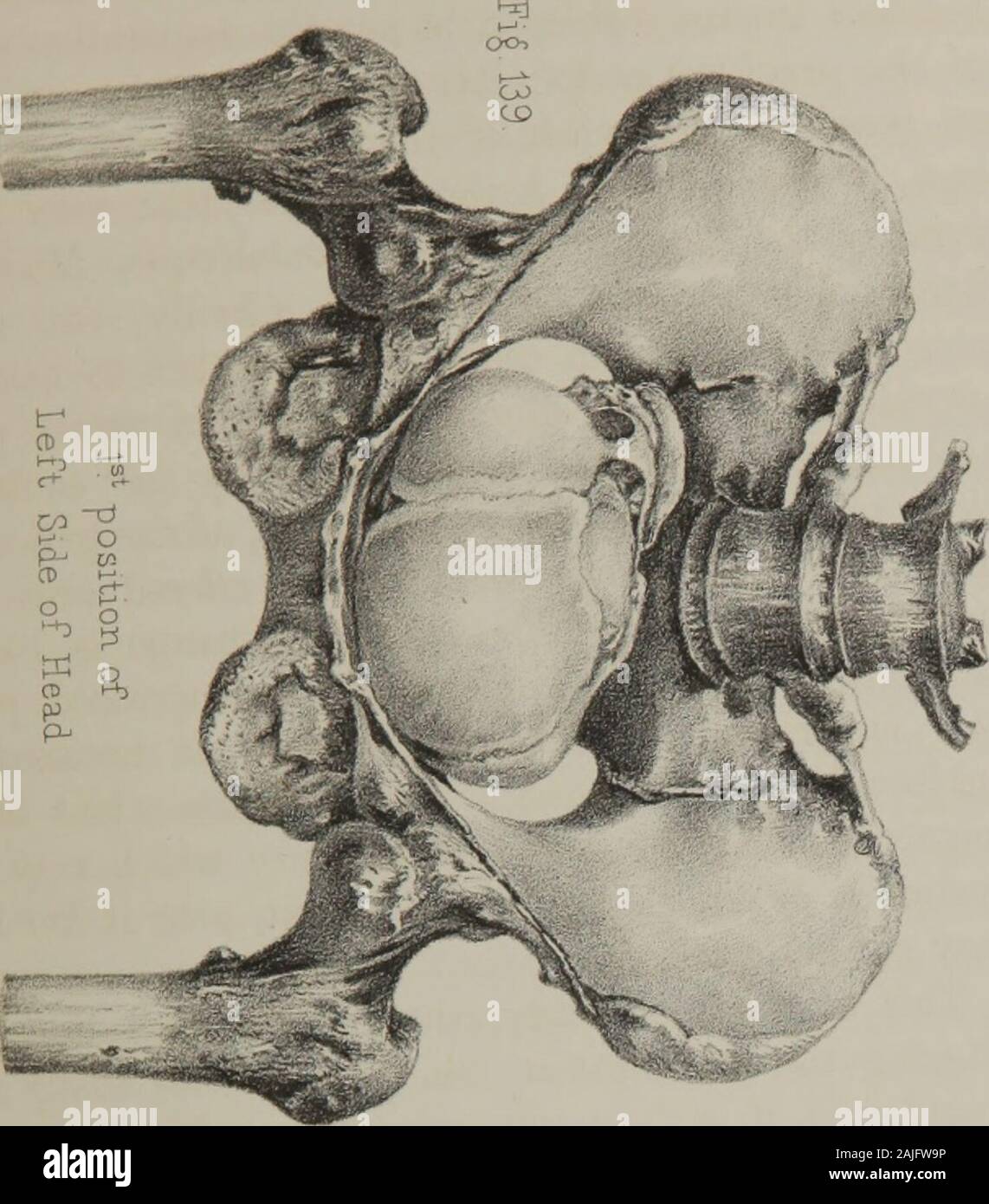 The principles and practice of obstetrics . e directed upon the leftside of the childs head, which will, of course, facili-tate, not only the descent of the head, but a lateralflexure, the neck being retained toward the rightshoulder; that is, the top of the head may thus glideupon the posterior part of the brim downward into thecavity—this lateral flexure being made on the fingersof the practitioner, as upon a fulcrum or prop. If this should not be effectual, the same lateralflexure might be accomplished by means of the lever,passed in the direction of the cervico-bregmatic diam-eter over the Stock Photo