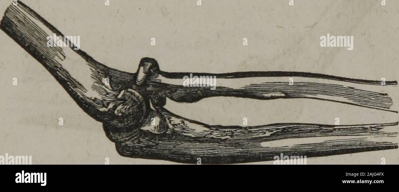 The homeopathic practice of surgery : together with operative surgery . OP THE ULNA BACKWARDS. The olecranon can be clearly felt behind the humerus. Thearm can be neither straightened, nor flexed to more than a rightangle. The distinguishing mark of the case is a backward pro-jection of the ulna, together with a twisting inwards of the fore-arm and hand. The same mode of reduction may be directed as in the other * Cooper on Dislocations and Fractures, p. 389. OF ULNA OR RADIUS ALONE — REDUCTION. 59 cases. It is generally more easily accomplished. The bendingof the arm is here the essential par Stock Photo