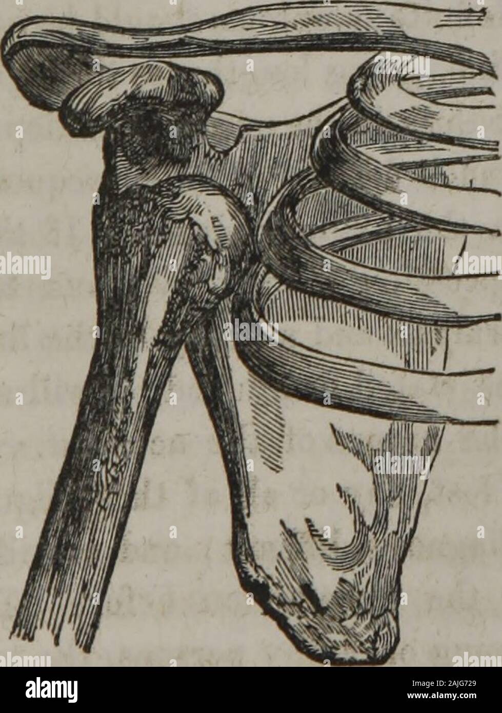 The homeopathic practice of surgery : together with operative surgery . ity, may be pushed or pulled downwards, forwards, or backwards:— In the first variety, the head of the bone is found in the axilla,or resting under the lower side of the inferior costa of the scap-ula. In the second, it is thrown forward upon the pectoral mus-cles, below the middle of the clavicle, between the coracoid pro-cess and the sternum. In the third case, the head is thrown upto the higher and back part of the inferior costa, or dorsum of thescapula, where the large protuberance can be distinctly felt andseen. The Stock Photo