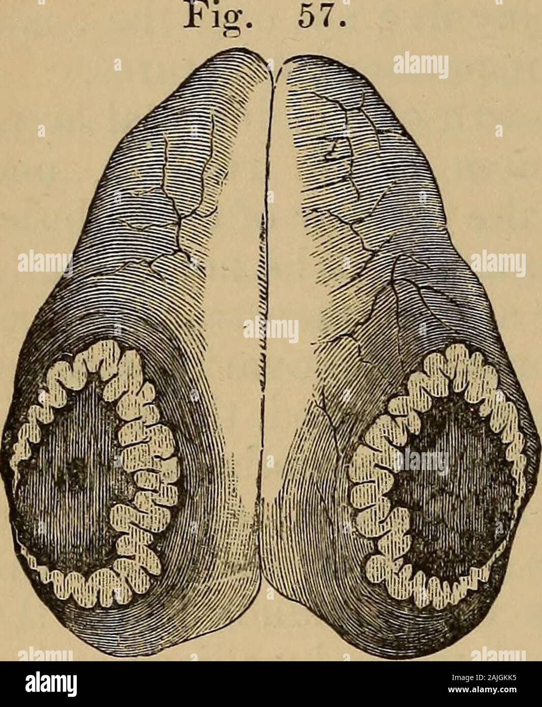 A treatise on the science and practice of midwifery . follicle, the cells of which have become greatly hyper-trophied and loaded with fat granules previous to rupture, is throwninto numerous folds. The greater the amount of contraction thedeeper these folds become, giving to a section of the follicle anappearance similar to that of the convolutions of the brain (Fig. 37).These folds in the human subject are generally of a brignl yellowcolor, but in some of the mammalia they are of a deep red. The tinlwas formerly ascribed by Raciborski to absorption of the coloringmatter of the blood-clot cont Stock Photo