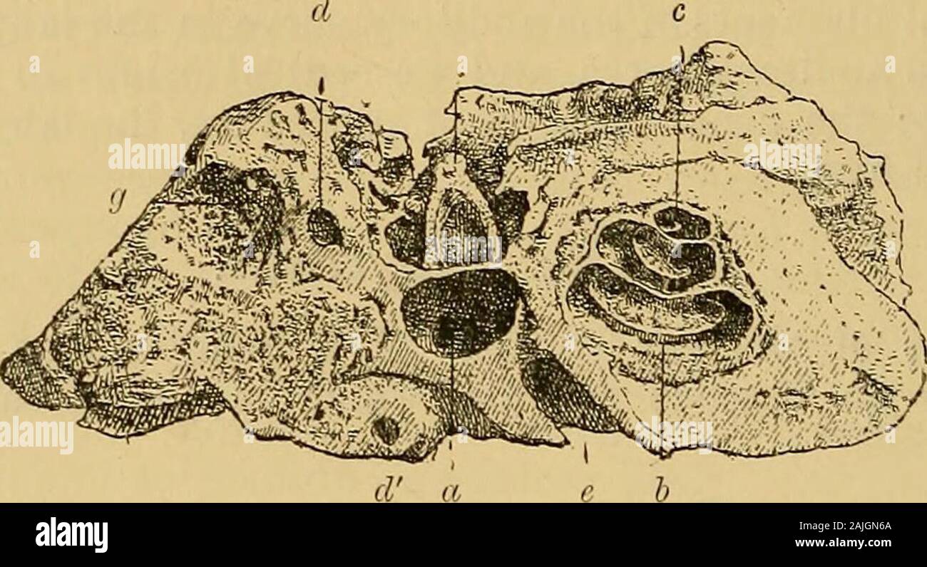 A text-book of the diseases of the ear for students and practitioners . ampullarum. On the inferior wall ofthe vestibule, below the fenestra ovalis, the beginning of the lamina spiralisossea and membranacea is seen (Fig. 308, sp) extending with a slight bendfrom within outwards towards the entrance of the scala vestibuli. On themacerated temporal bone, by destruction of the commencement of themembranous spiral plate, a cleft is formed through which the vestibule com-municates with the scala tympani of the cochlea. On the anterior border ofthe external and inferior vestibular walls another open Stock Photo