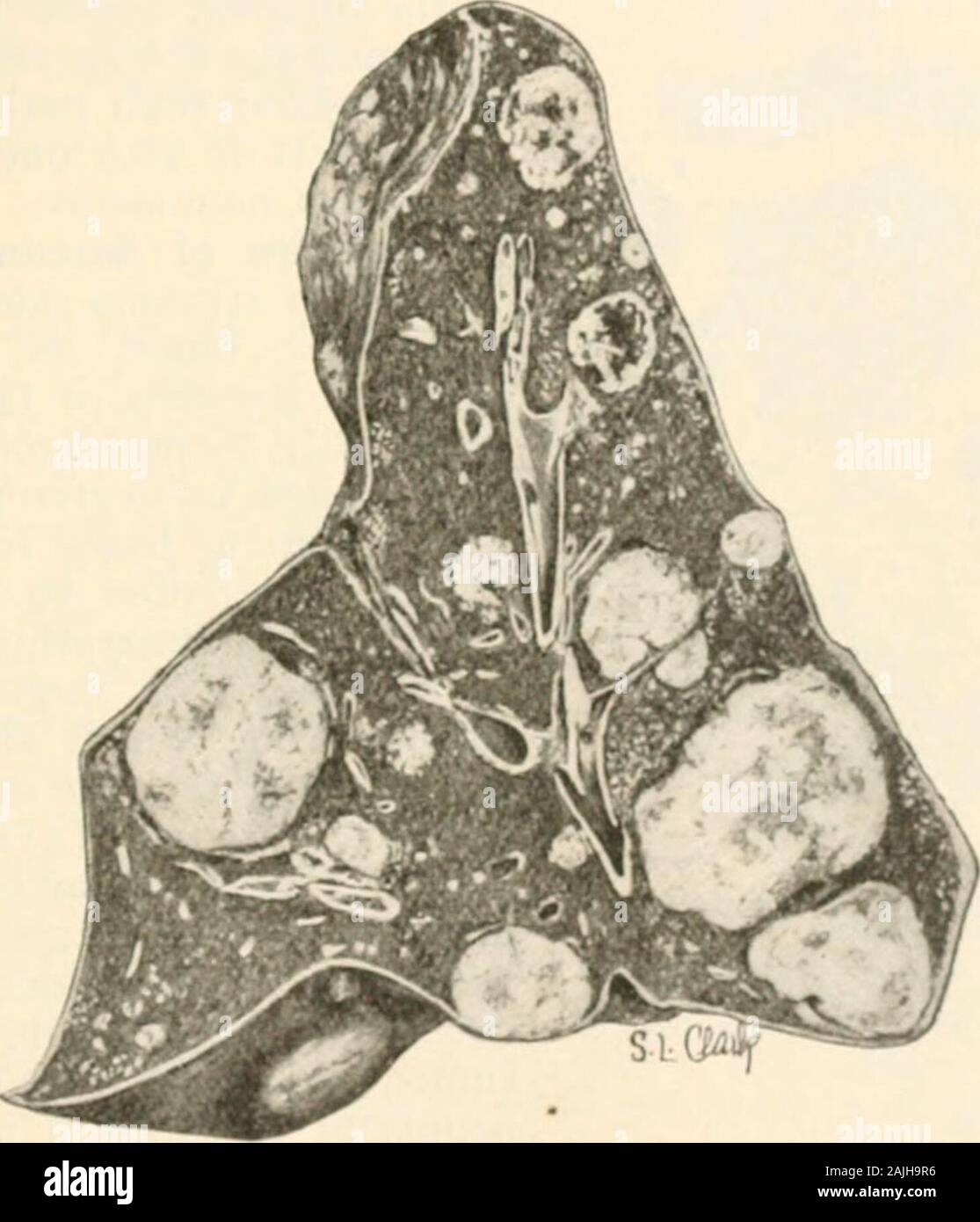 Manual of pathology : including bacteriology, the technic of postmortems, and methods of pathologic research . Soc. de Biol., 1904, Ivi, p. 153. See technic of Blood Examination, Part III, Chapter I. TTMokS. 351 equivalent to saying that the nion- tluid the intercellular sul&gt;stance,the more malignant the tumor. Fluidity of the intercellular substanceimplies that the neoplastic cells are loosely bound together; this lackof cohesion between the elements of the tumor permits of the readydislodgement of one or more cells, or masses of cells, and hence favorsdisplacement of the tumor elements in Stock Photo