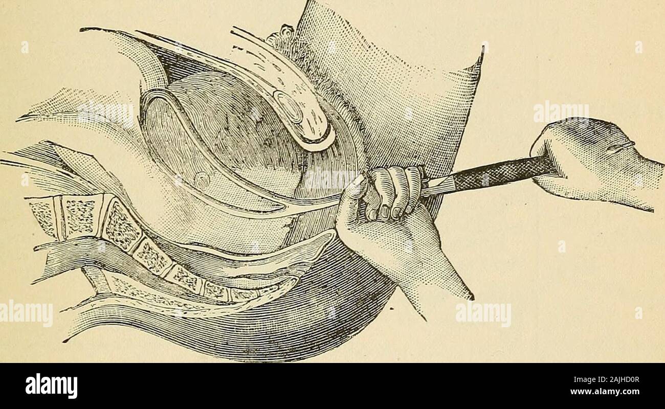 Cyclopædia of obstetrics and gynecology . ht blade isinserted first, behind and to the right, over the left maxillary angle, theleft blade, second, behijid, is brought forward spirally and placed overthe right frontal protuberance. The lesser curve is tovards the mothers THE FORCEPS. 135 right tliigli. Crossing, or Stoltzs method, is necessary. Traction down-ward to bring down the face and chin rotation from right to left, extrac-tion witli chin to pubes. 8. Position M.I.R.P.—The fronto-mental diameter points by the chinto the right sacro-iliac synchondrosis, by the forehead to the left cotylo Stock Photo
