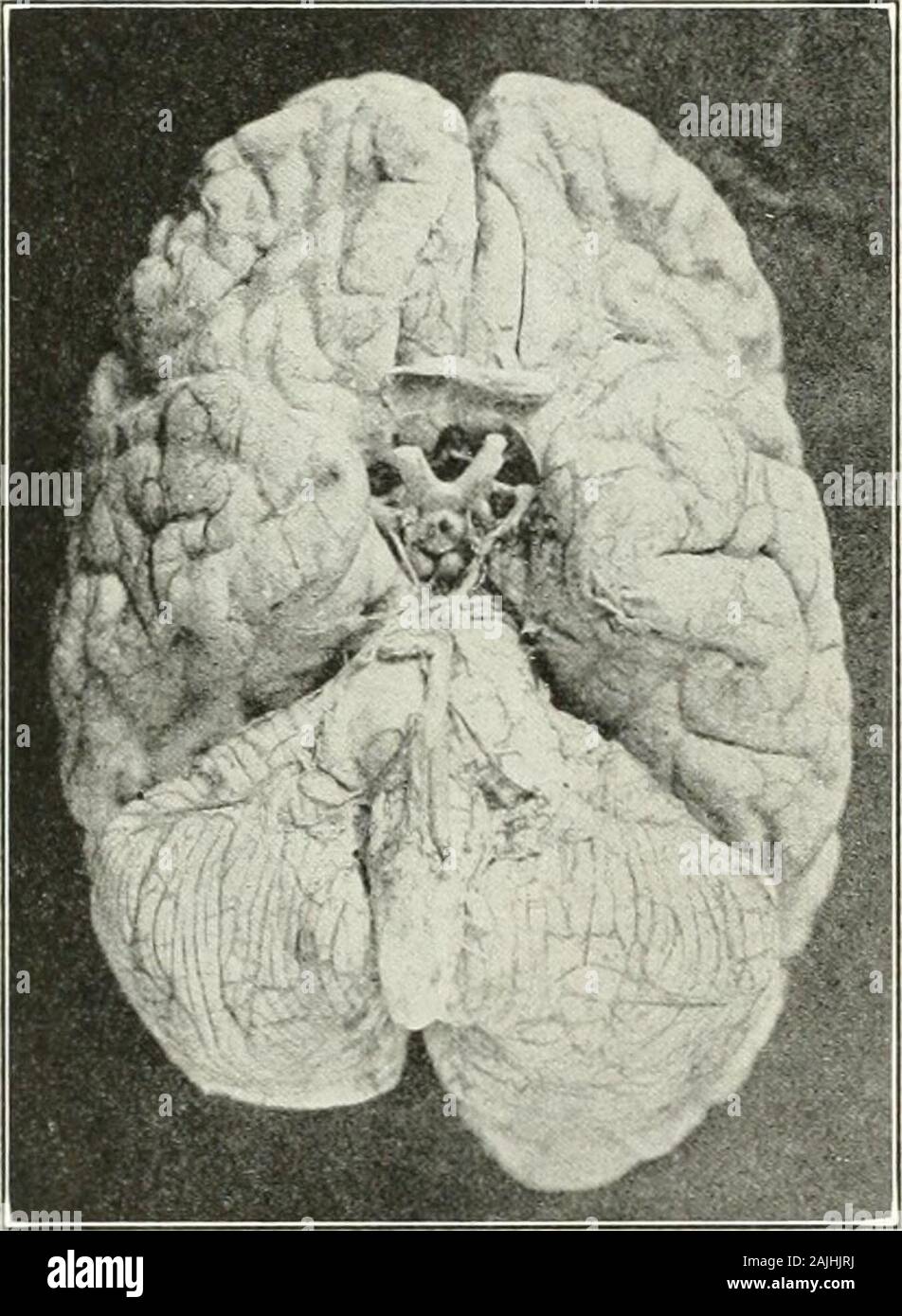 A reference handbook of the medical sciences, embracing the entire range of scientific and practical medicine and allied science . gularly. Occasionallyeven the movements of the face, both volitional andexpressional, are ataxic and dysmetric; while speechis even more frequently affected than in acute cere-bellar disease, being slow and drawling, or explosiveand scanning. Nystagmus is, on the other hand, notso common or so characteristic. Vertigo is a frequentsj-mptom; it is usually of the indefinite varietv, and notaccompanied by any definite sense of rotation of self orof external objects. In Stock Photo