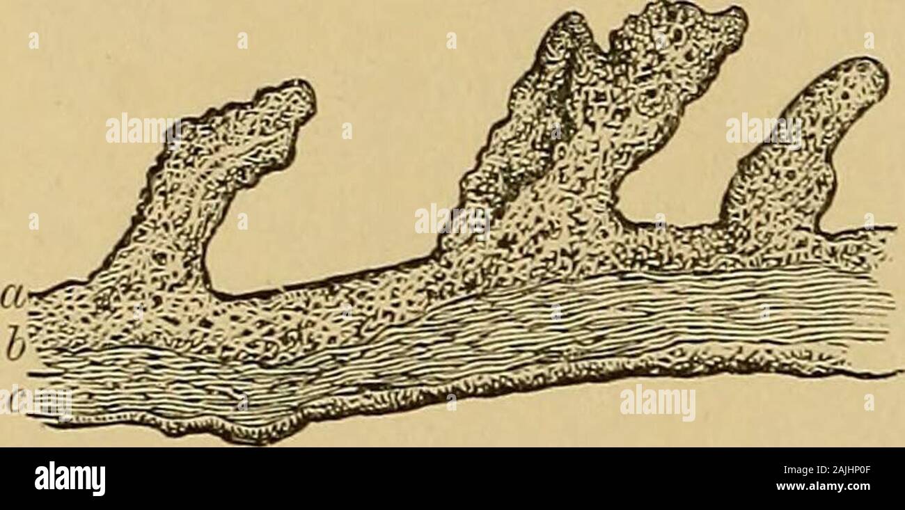 A text-book of the diseases of the ear for students and practitioners . tory in a Phthisical Person,27 Years Old, who had Otorrhea since Childhood. (Right Ear.)(Hartnack, Obj. 7.) adhesions between the membrana tympani, ossicles, and tympanic walls.Such connective-tissue growths may either remain permanent or they mayshrink, become sclerotic, calcify, and ossify, or the mucous membrane maybecome atrophied. (4) The suppurative process may lead to destruction of thetissue, to ulceration and destruction of the mucous membrane, which may bedestroyed to the bone, whereupon the ulceration may involv Stock Photo