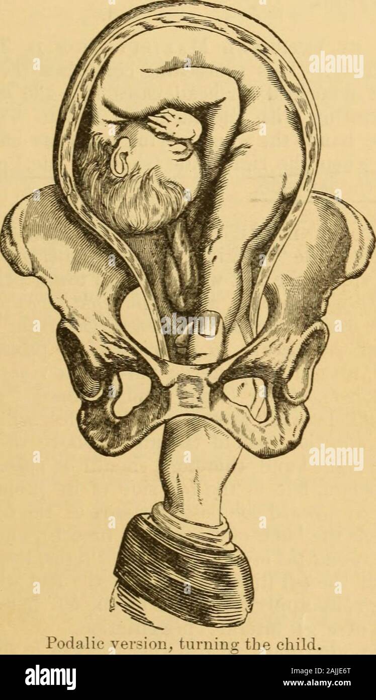 A manual of practical obstetrics . Podalic version, grasping the feet ...