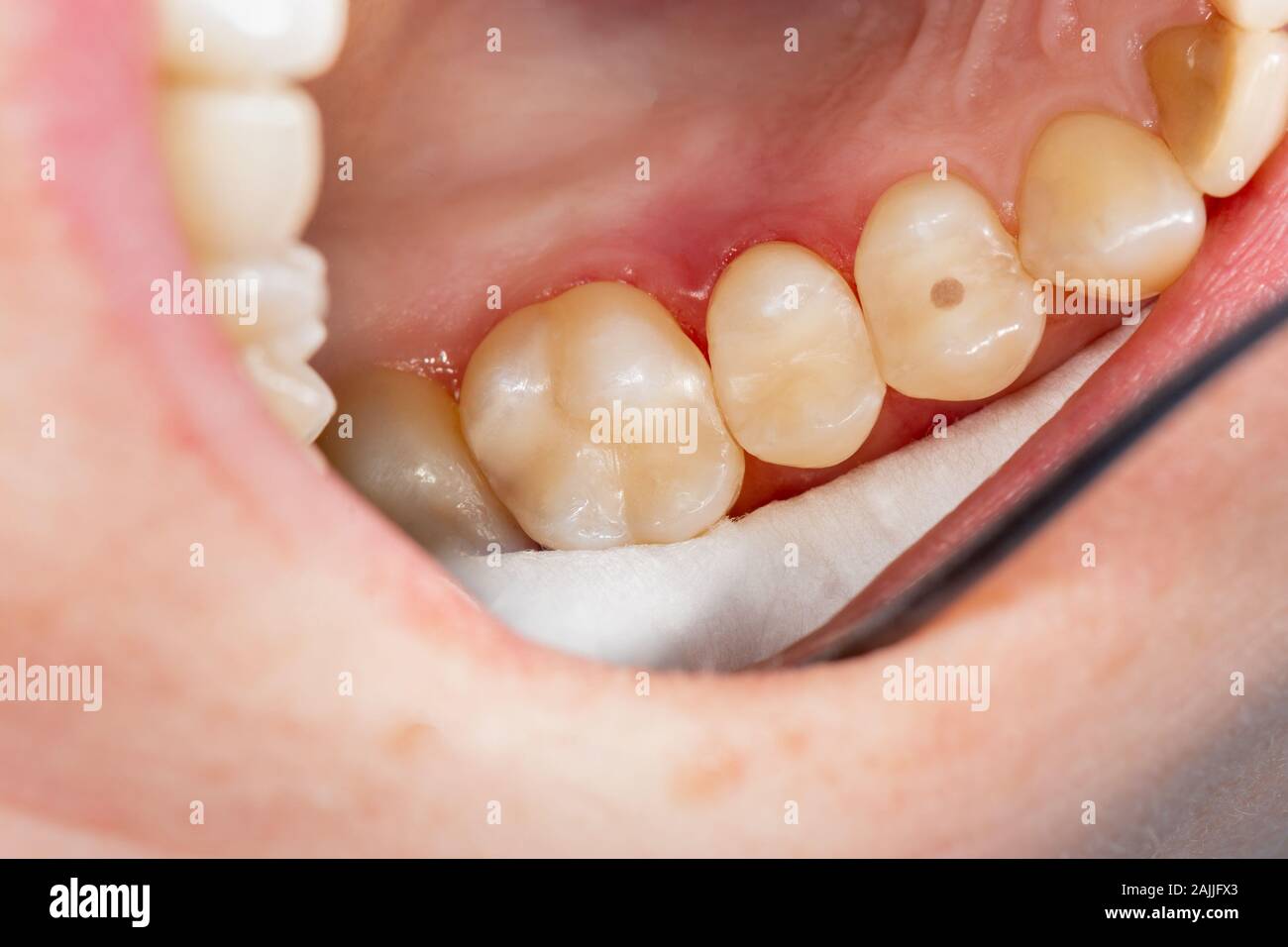 two chewing side teeth of the upper jaw after treatment of caries