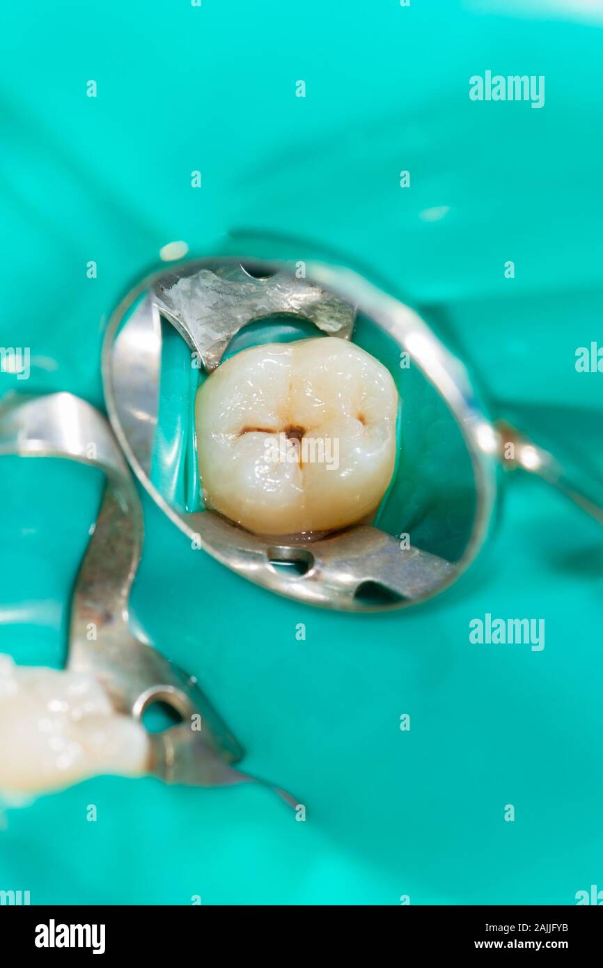 Dental caries. Filling with dental composite photopolymer material using rabbders. The concept of dental treatment in a dental clinic Stock Photo