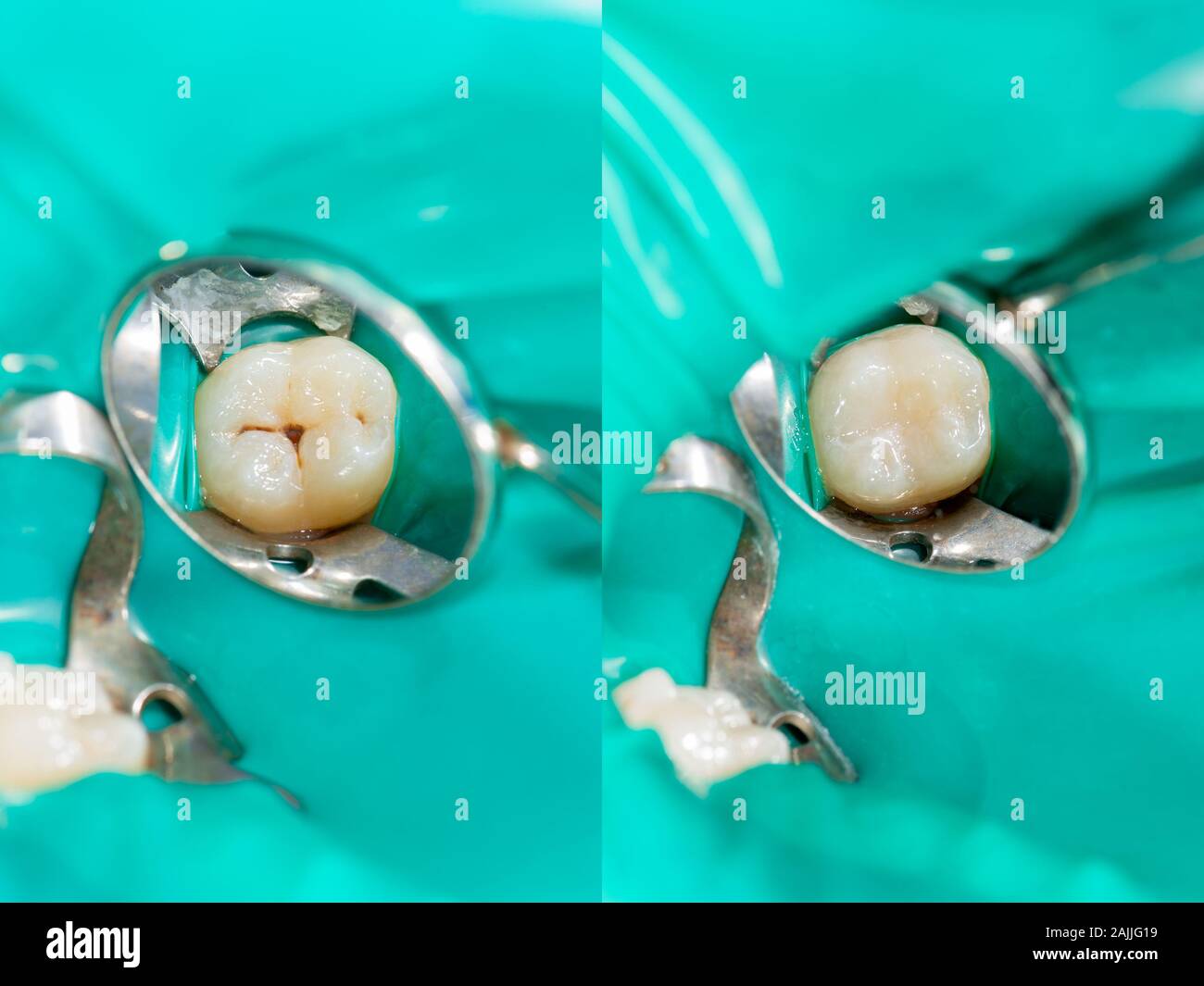 Dental caries. Filling with dental composite photopolymer material