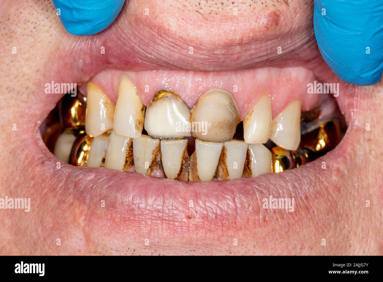 Dental caries. Filling with dental composite photopolymer material using Rubber Dam. The concept of dental treatment in a dental clinic Stock Photo