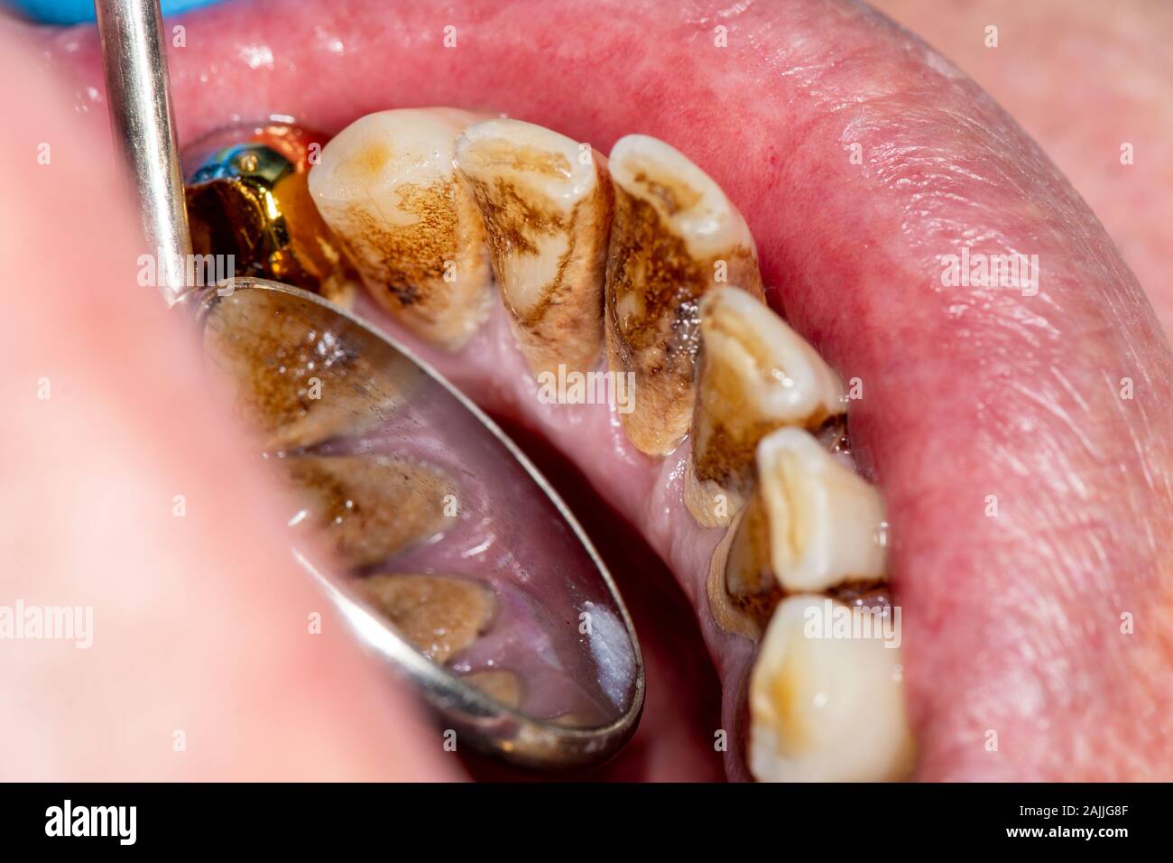 Closeup of macro dental calculus and dental plaque. Oral hygiene in