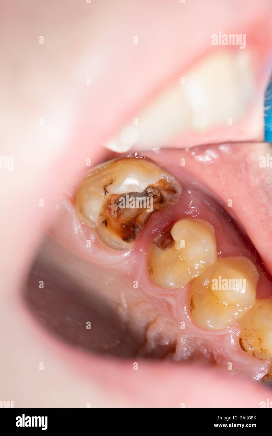 Dental caries. Filling with dental composite photopolymer material