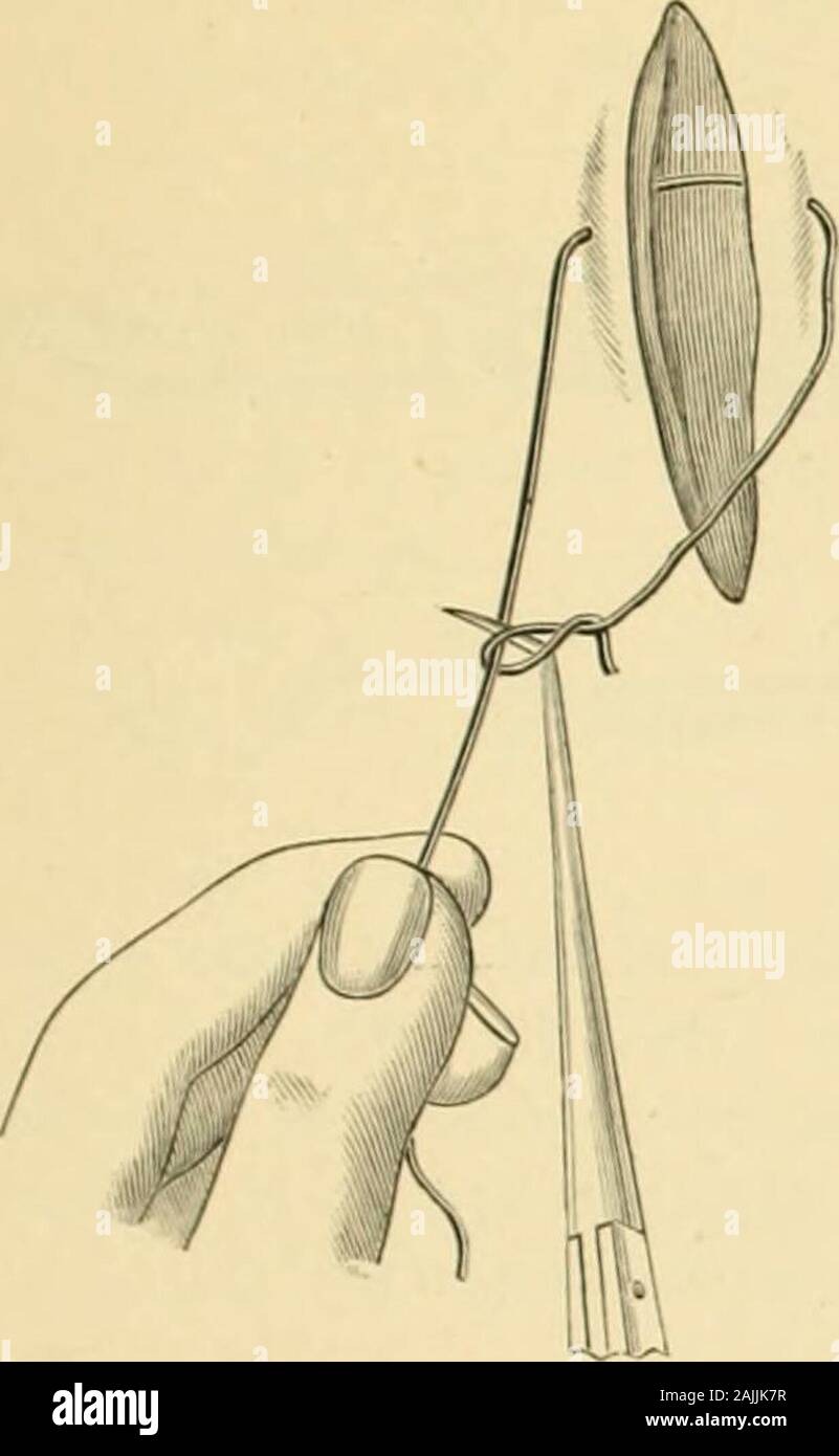 A system of gynecology . ng separated from the others by a tenac-ulum ...
