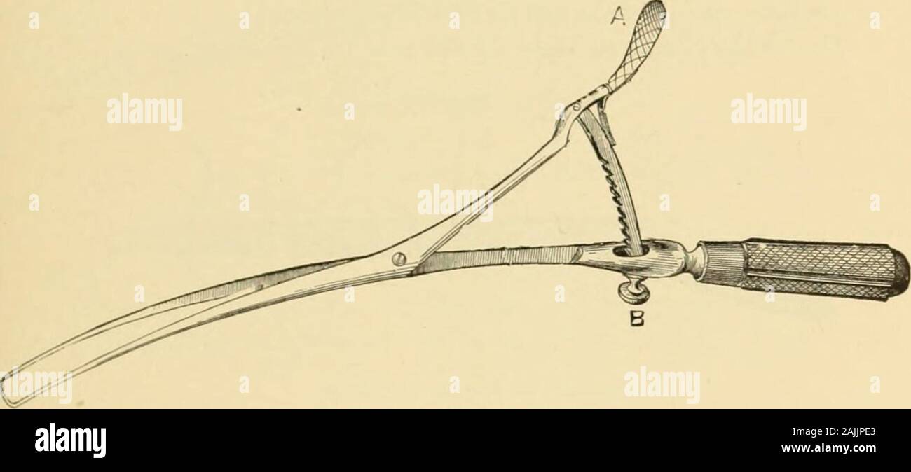 A system of gynecology . Emmets Double Tenaculum Forcepsin the left hand, and may be introduced into the cervical canal with itst.cth adjusted, as in Fig. 141 ; then by depressing the thumb-piece atA the blades are widely separated, the canal put upon the stretch, andits opposite walls penetrated and held by the teeth. Its hold upon the Fig. Hi.. Emmets Double Tenaculum. tissues may he loosened by drawing bach the ratchet at B with theindex finger. Sponge-Holders.—For intravaginal operations three or four or more Fig. 142. Stock Photo