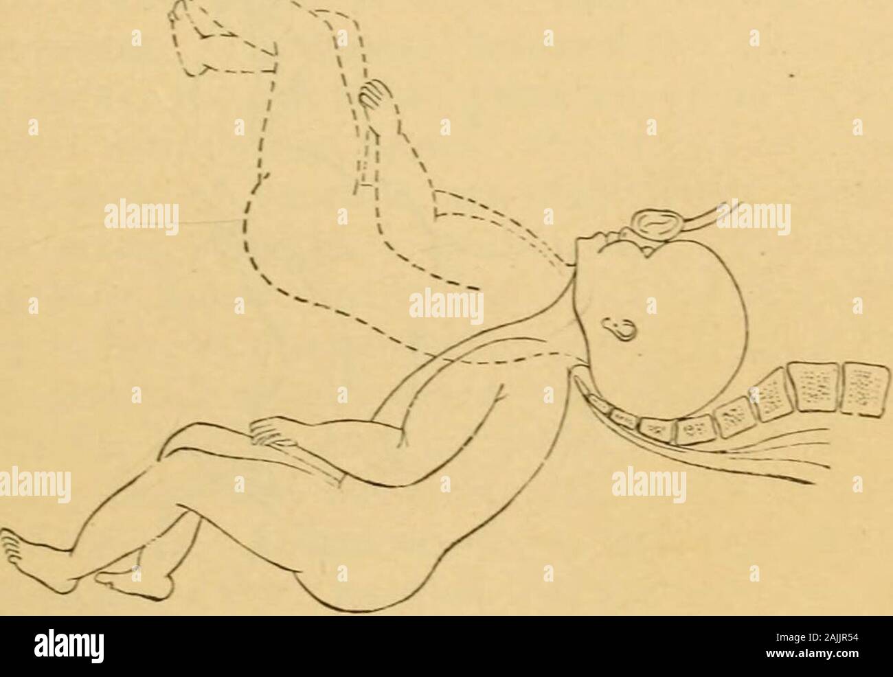 A manual of practical obstetrics . ineum. Mechanism in Left Sacro-posterior Position (Sacrumto Left Sacro-iliac Synchondrosis).—Moulding, descent,rotation, and delivery of the breech; and descent, rotation,and delivery of the shoulders exactly as already described for&lt;interior positions of the sacrum. Flexion and descent of the head are also the same, exceptthat the occiput enters the pelvis directed toward the left sacro-iliac synchondrosis instead of toward one of the acetabula.Hence rotation of the occiput takes place, in the majority of LEFT SACRO-POSTERIOR POSITION. 213 cases, all the Stock Photo