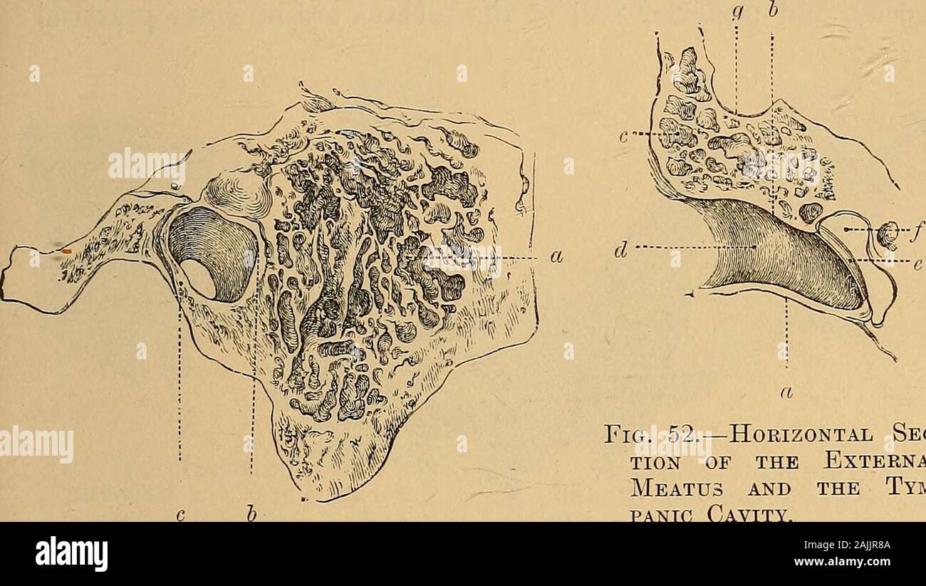 A text-book of the diseases of the ear for students and practitioners . e pneumatic cells of the mastoid process are lined with a delicate mem-brane which is a continuation of the mucous membrane of the tympaniccavity ; it is closely united to the periosteum, and has a layer of non-ciliated THE CELLS OF THE MASTOID PROCESS 47 squamous epithelium. One often finds membranes of connective tissue andbranch-like bands in the antrum, upon which the pedunculated bodies lie,discovered by the author and described on p. 36 (Fig. 42). The cells of the mastoid are bounded anteriorly -by theposterior end o Stock Photo