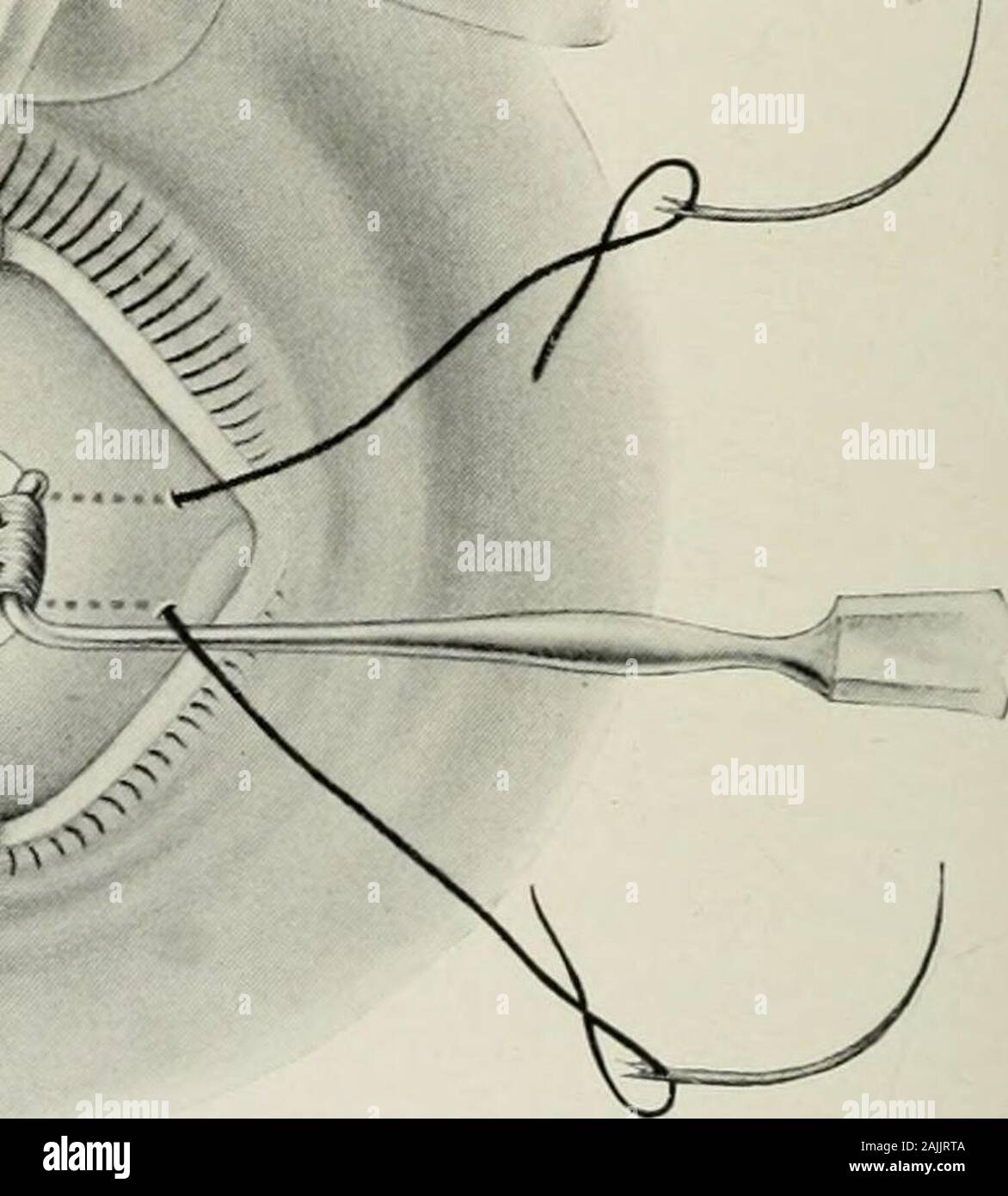 Transactions Fig 9 Third Stage Both Needles Have Been Passed Back Under Ten Ons Capsule And Out To Conjunctiva A Wedge Or V Shaped Piece Is Beingexcised From Each Margin Ziegler Capsulo Muscular Advancement 627 Transactions Fig 9 Third Stage Both Needles Have Been Passed Back Under Ten Ons Capsule And Out To Conjunctiva A Wedge Or V Shaped Piece Is Beingexcised From Each Margin Ziegler Capsulo Muscular Advancement 627
