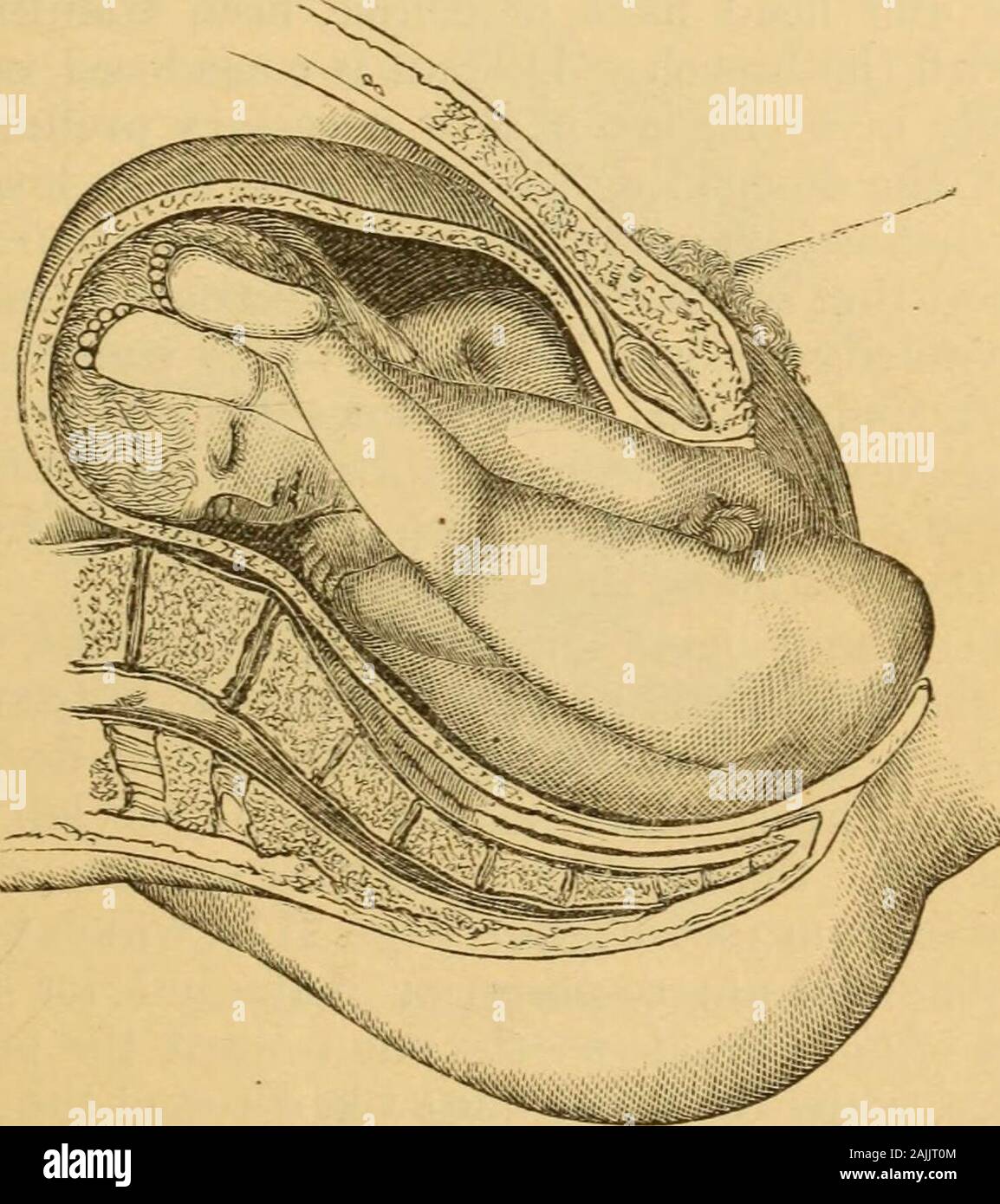 A Manual Of Practical Obstetrics Breech Presentation legs Extended a-manual-of-practical-obstetrics-breech-presentation-legs-extended