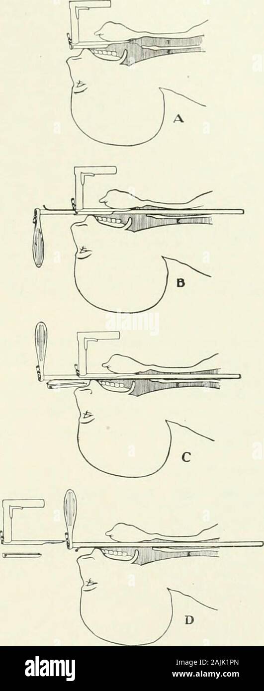 A reference handbook of the medical sciences, embracing the entire range of scientific and practical medicine and allied science . betold to take a deep inspiration. If profoundlyanesthetized, no halting of the ryhthmic respiratoryexcursions is noticed and the bronchoscope is readilyintroduced into the trachea. The inexperienced will often find that the bron-choscope has gone into the esophagus. In a casewith great dyspnea this may be fatal not only by de-fault in not entering the trachea, but also directly bythe compression due to the bulk of the tube in theesophagus plus the bulk of the fore Stock Photo