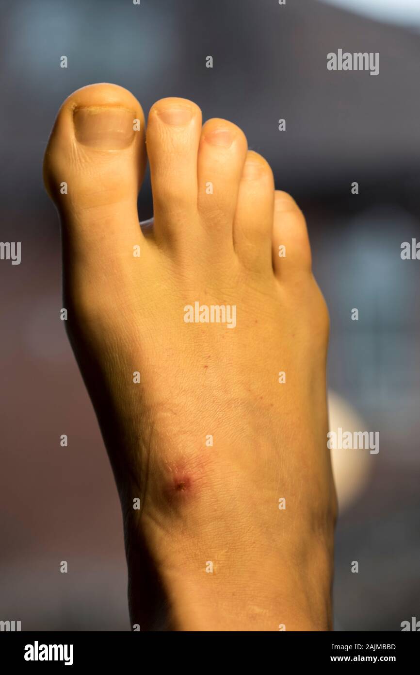 Foot close up with ulceration from being in a cast for healing a broken leg. Red skin with scab in the center. Foot ulcer on patient with broken leg. Stock Photo