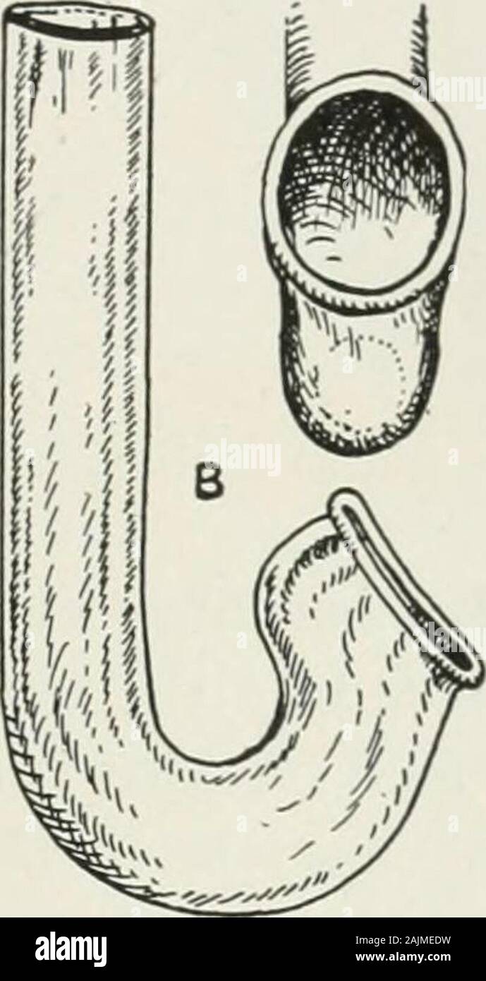 The American Encyclopedia And Dictionary Of Ophthalmology Edited By Casey A Wood Assisted By A Large Staff Of Collaborators Glass Nasal Tubes For General Anesthesia In Head Surgery Be Fraught With The