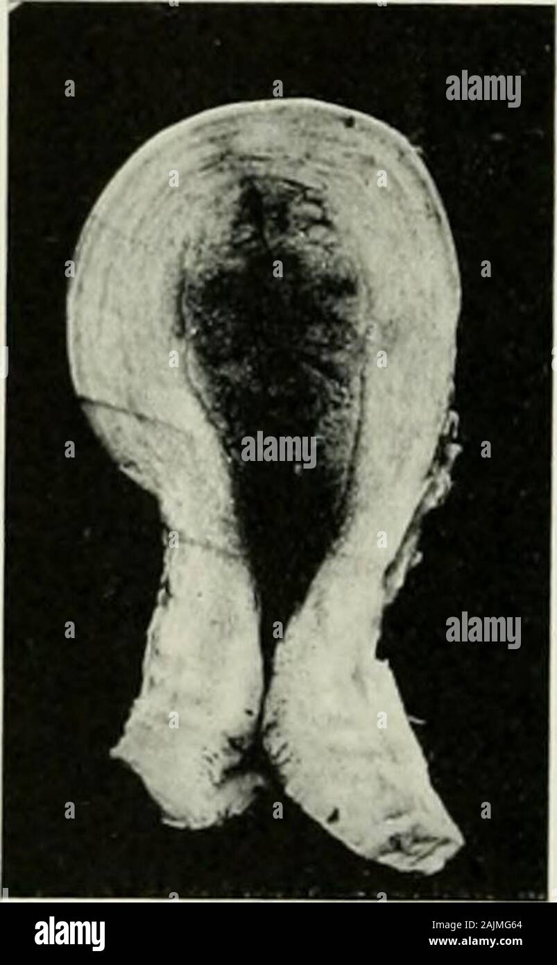 Gynecological diagnosis and pathology . Fig. 141.—Chorionic Villi from Case of Tidal Pregnancy (H.P.). 142 GYNECOLOGICAL PATHOLOGY Changes in the Tube and Uterus.—In the mucous membrane andmuscular wall of the tube there is a certain amount of reaction as theresult of the presence of the ovum. The blood-vessels dilate, the endo-thelium lining them proliferates, and some of these endothelial cells mayfind their way outwards into the tissues of the part. The connective-tissue cells proliferate and enlarge and may take on an appearance verylike that of true decidual cells. The relation of the cho Stock Photo