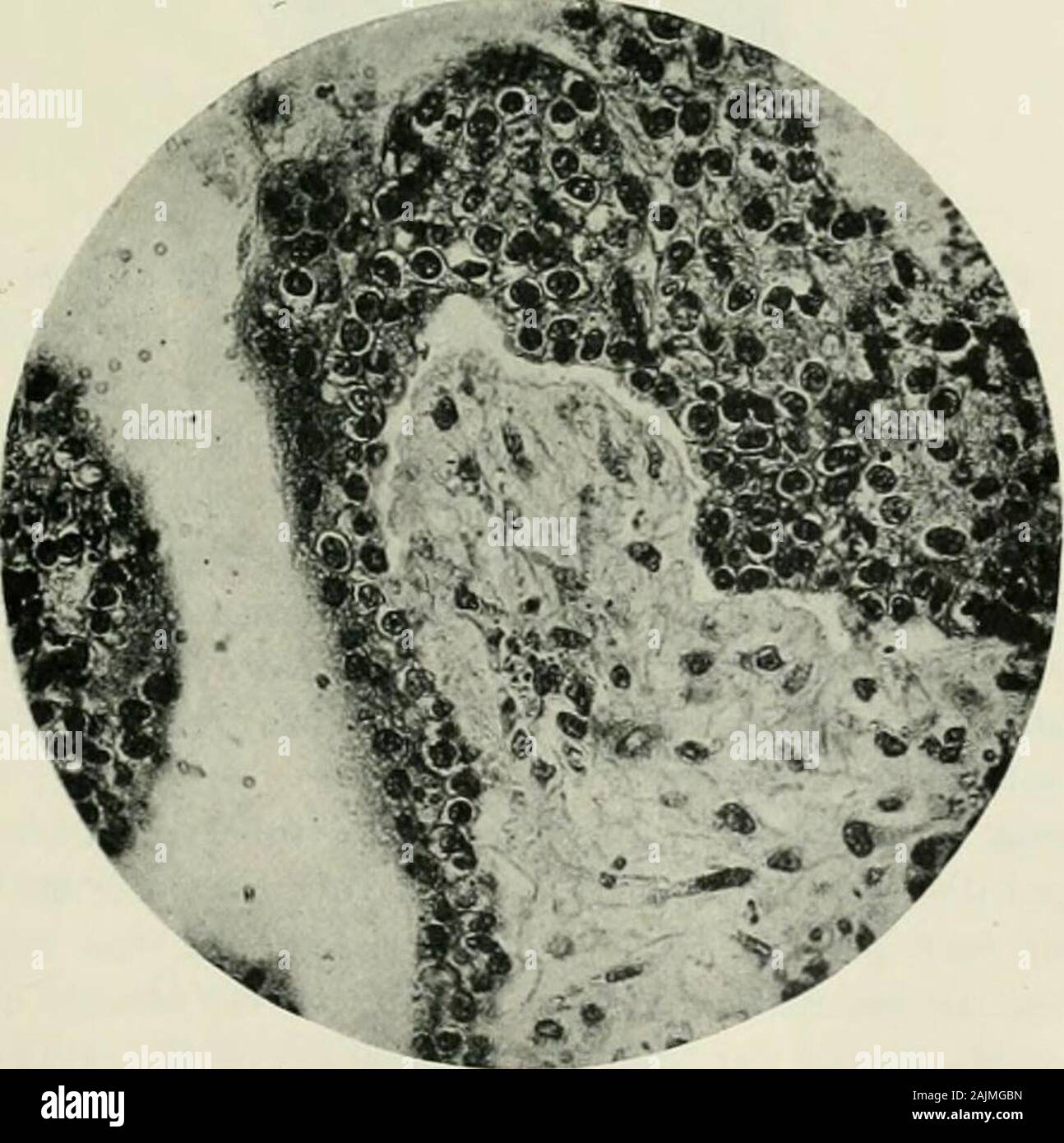 Gynecological diagnosis and pathology . Fig. 140.—Chorionic Villi from Cask of Tubal Pregnahcy(L.P.). Note the stroma of embryonic tissue and the covering of epithelium] Langhanslayer and syncytium.. Fig. 141.—Chorionic Villi from Case of Tidal Pregnancy (H.P.). 142 GYNECOLOGICAL PATHOLOGY Changes in the Tube and Uterus.—In the mucous membrane andmuscular wall of the tube there is a certain amount of reaction as theresult of the presence of the ovum. The blood-vessels dilate, the endo-thelium lining them proliferates, and some of these endothelial cells mayfind their way outwards into the tis Stock Photo