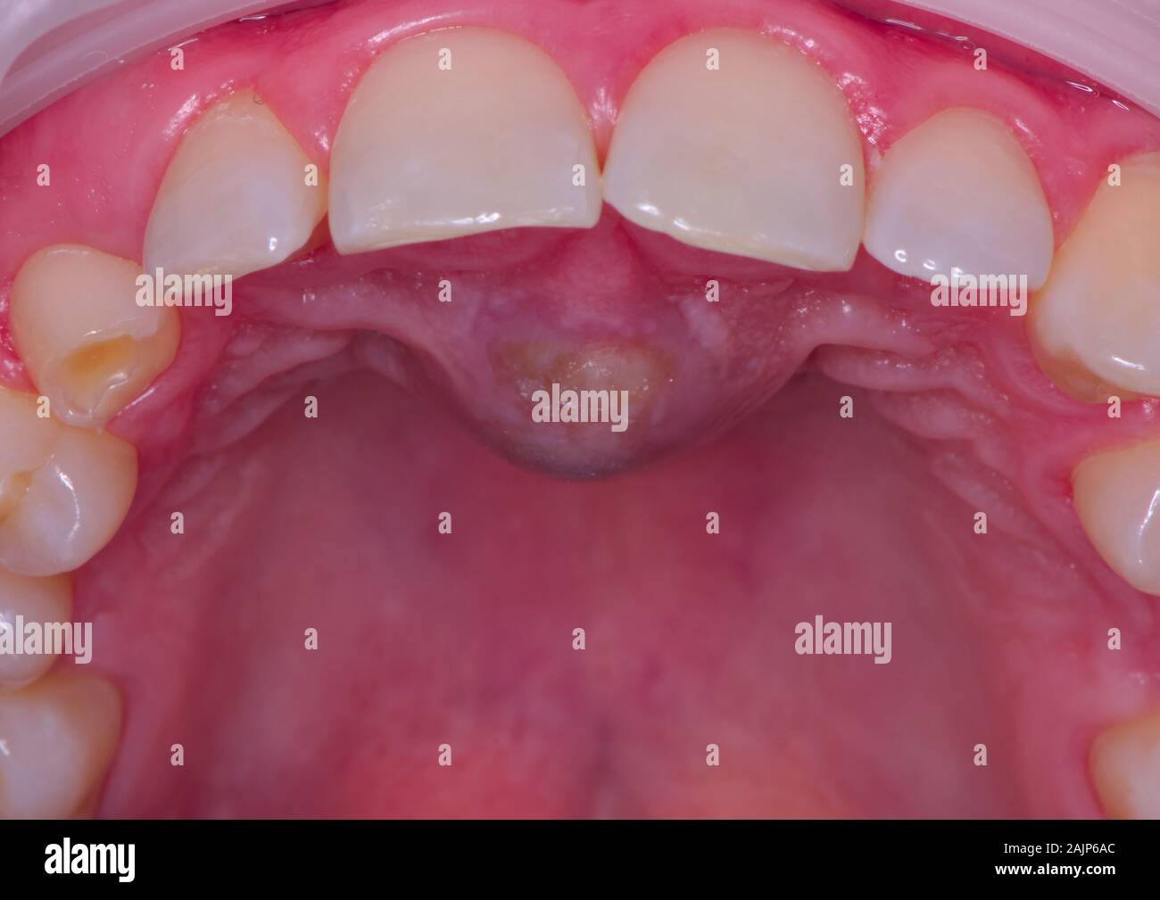 Palatal cyst hires stock photography and images Alamy
