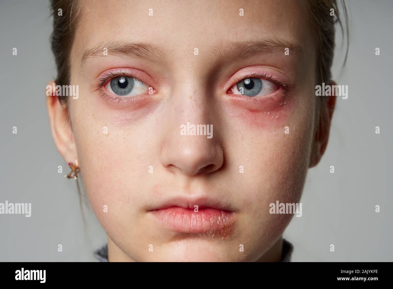 Allergic reaction, skin rash, close view portrait a girl's face. Redness and inflammation of the skin in the eyes and lips. Immune system disease Stock Photo Alamy