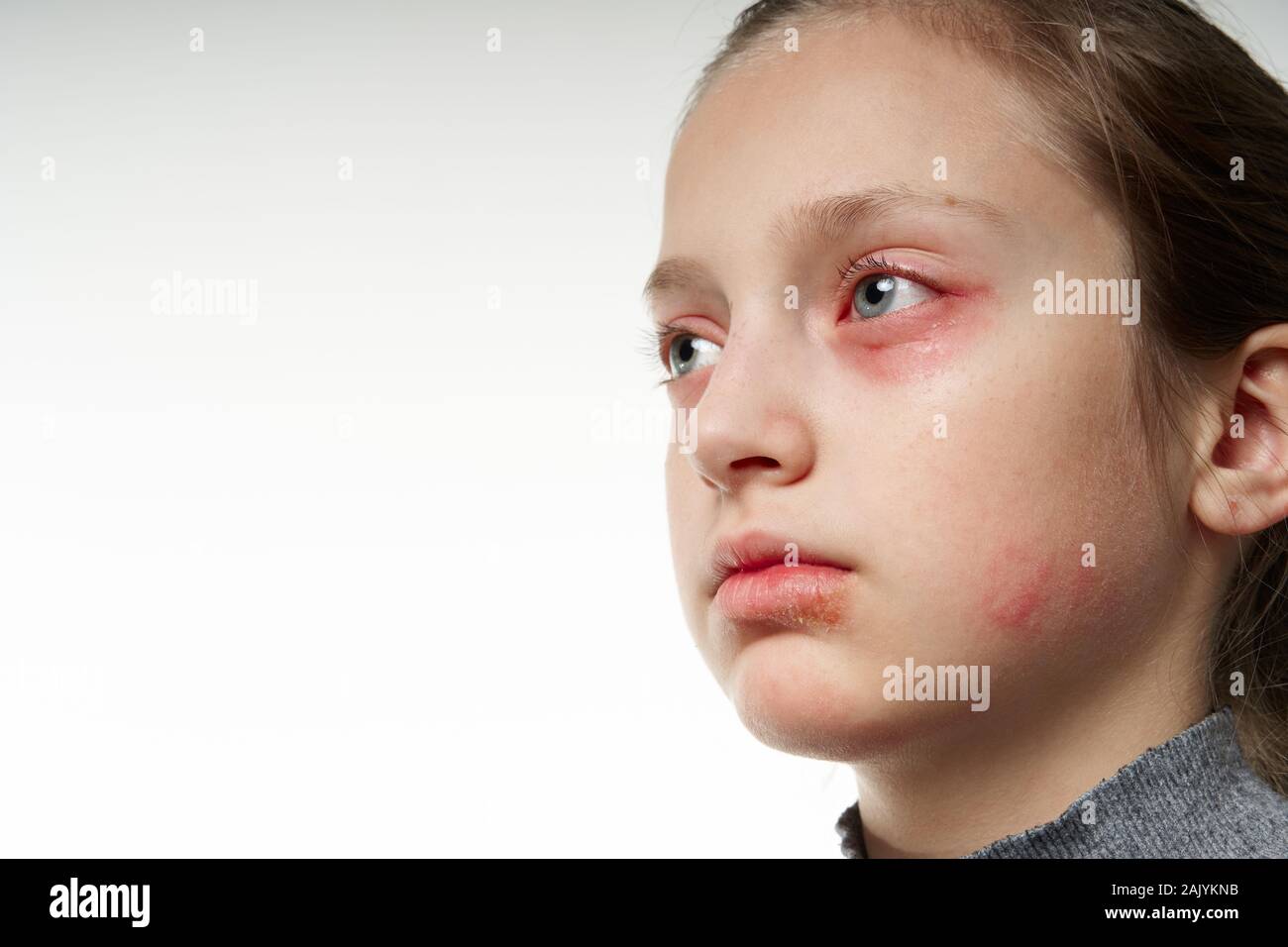 Allergic reaction, skin rash, close view portrait of a girl's face. Redness and inflammation of