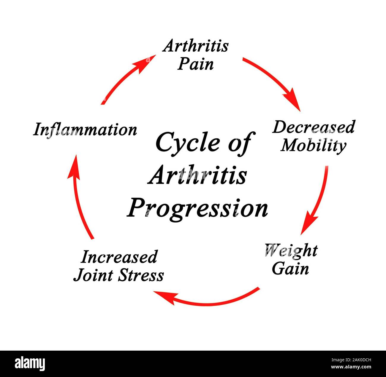Steps in Cycle of Arthritis Progression Stock Photo Alamy