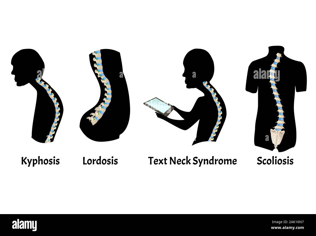 The position of the spine with lordosis, kyphosis. Text Neck Syndrome. Spinal  curvature, kyphosis, lordosis, scoliosis, arthrosis. Poor posture and Stock  Vector Image & Art - Alamy