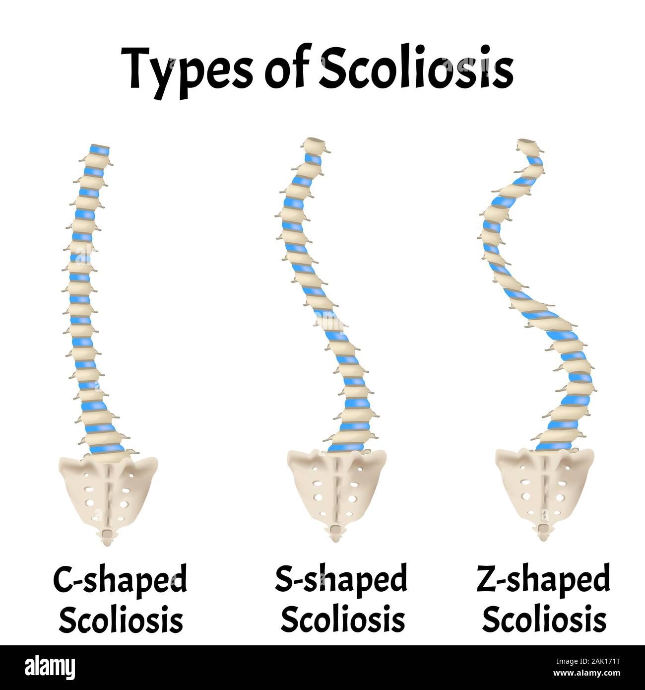 Types Of Scoliosis C S Z Shaped Scoliosis Dextroscoliosis Levoscoliosis Spinal Curvature Kyphosis Lordosis Arthrosis Infographics Vector Stock Vector Image Art Alamy