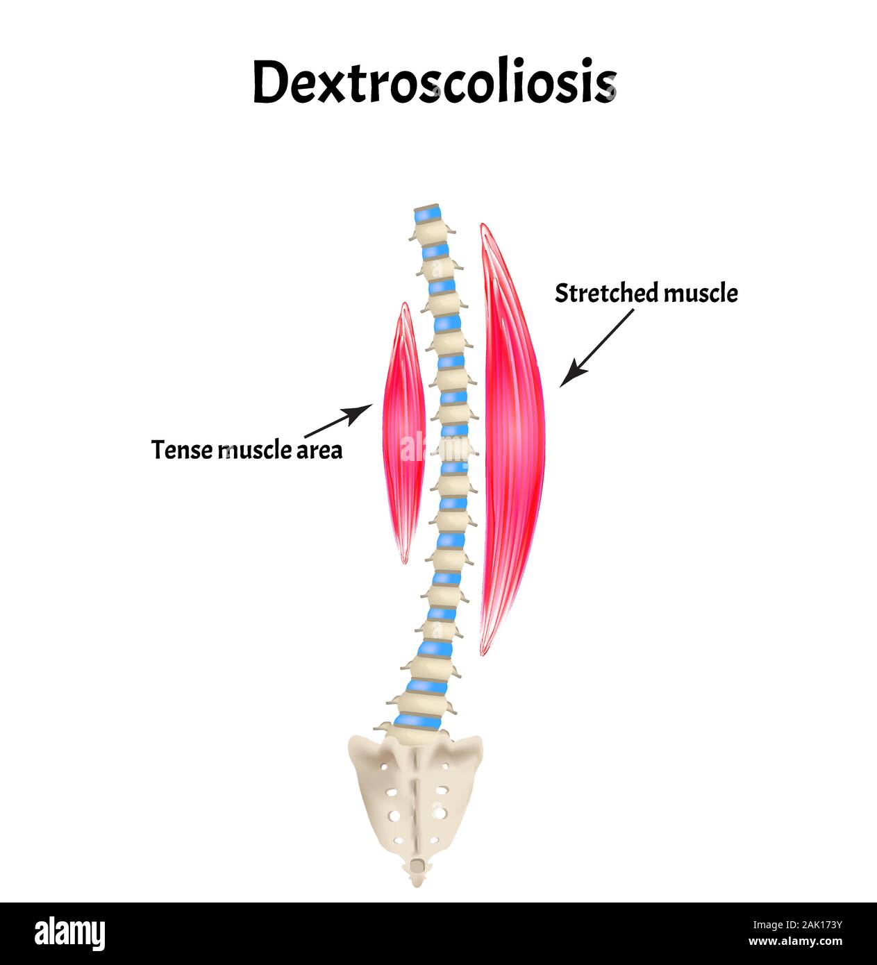 scoliosis Dextroscoliosis. Spinal curvature, kyphosis, lordosis ...