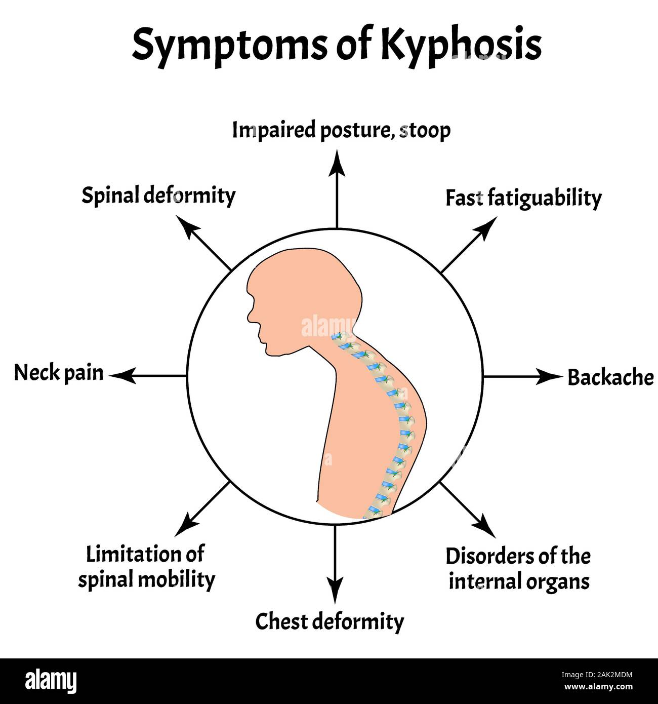 Symptoms of kyphosis. Spinal curvature, kyphosis, lordosis, scoliosis