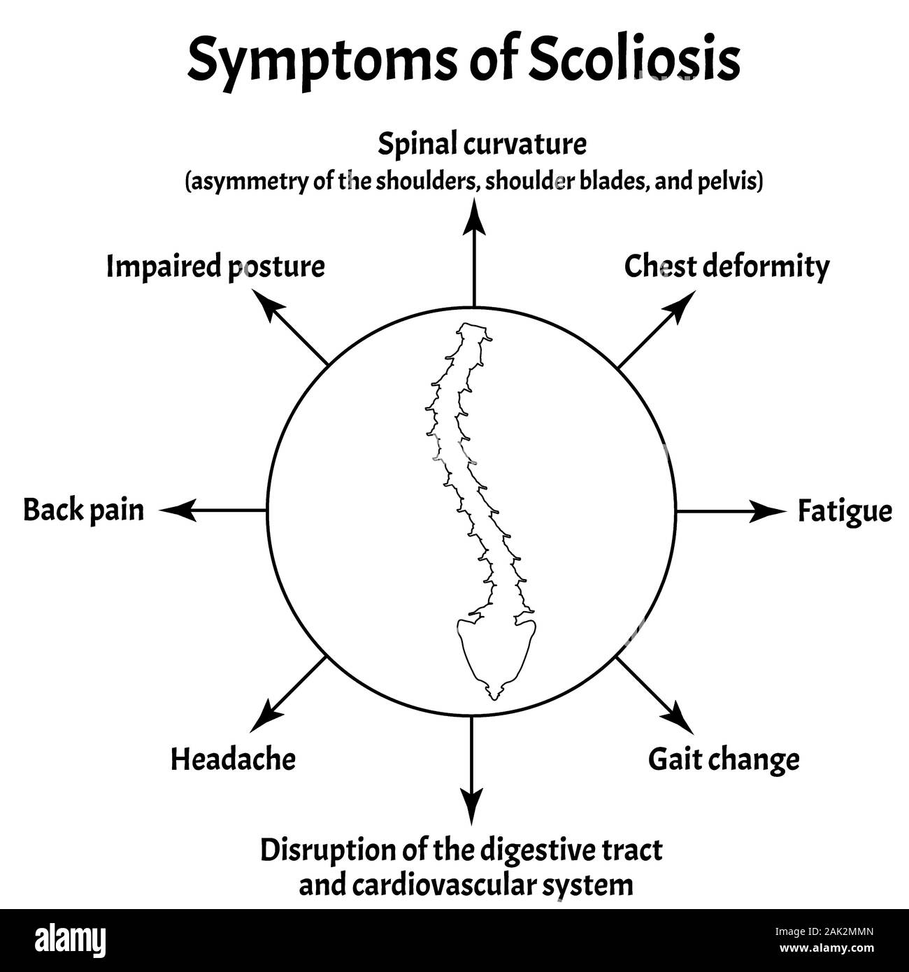 Symptoms of Scoliosis. Spinal curvature, kyphosis, lordosis of the neck