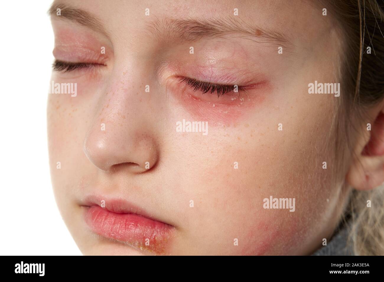 Allergic reaction, skin rash, close view portrait of a girl's face. Redness and inflammation of
