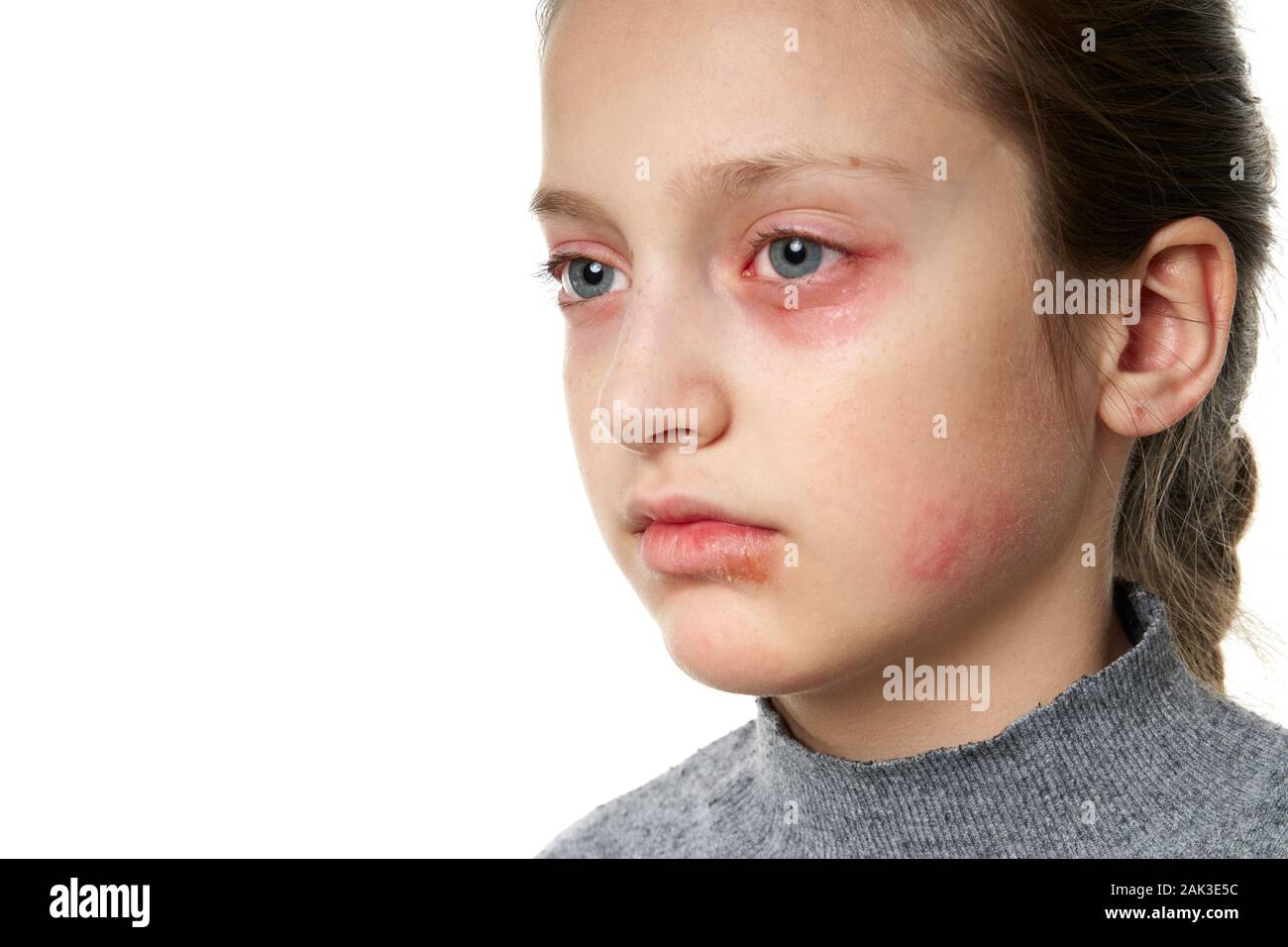 Allergic reaction, skin rash, close view portrait of a girl's face. Redness and inflammation of