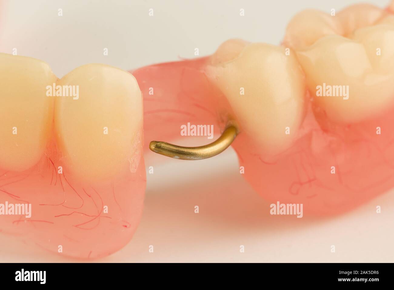 acrylic dental prosthesis with metal retaining elements Stock Photo