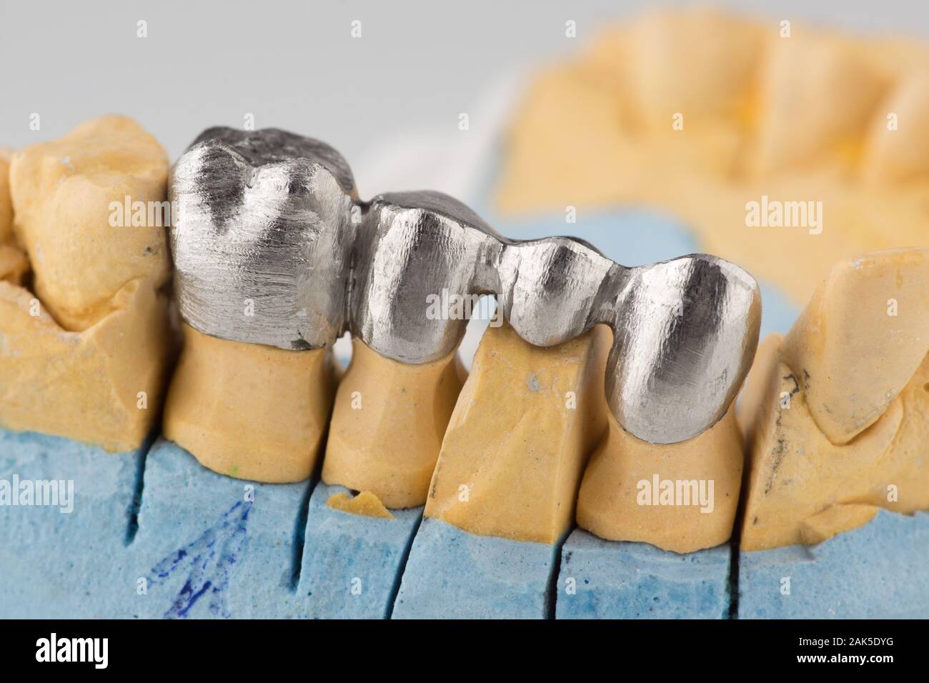 зуба под цельнолитую коронку. препарирование зубов под цельнолитые коронки. 36 зуб отпрепарированный под штампованную коронку. препарирование цельнокерамическую коронку. мостовидный протез препарирование.