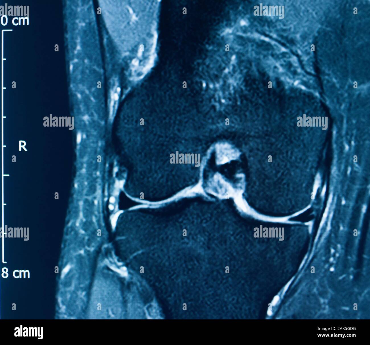 Knee sports injury mri mcl grade 2 tear magnetic resonance imaging ...